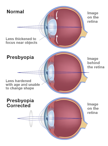 presbyopia graphic
