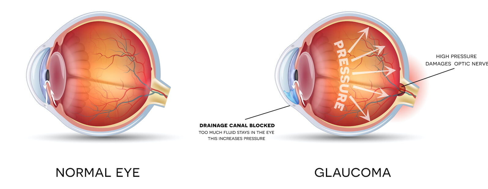 glaucoma diagram